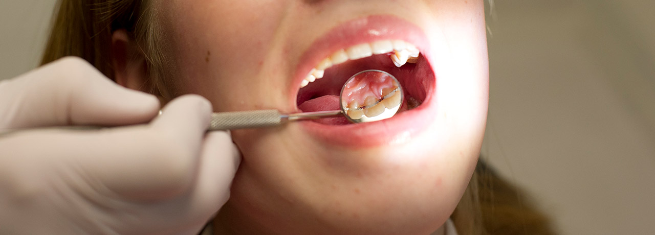 Lingualer Retainer im Mund einer erwachsenen Frau | Brand Orthodontics Mainz